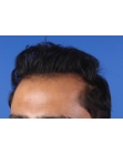 After Hair Transplant&nbsp;2 Sessions (Areas)